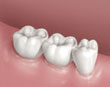 cemented dental bridge - colgate au