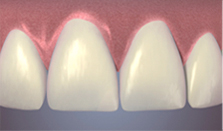 after bonding chipped tooth repair - colgate au
