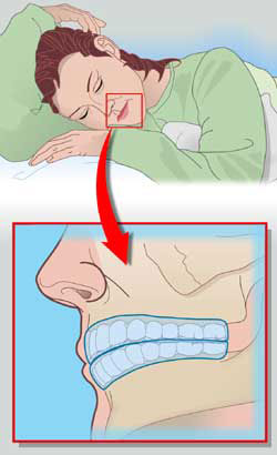 Bruxism