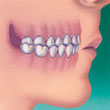 crossbite teeth and orthodontics - colgate au