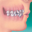 crowding teeth and orthodontics - colgate au
