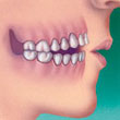 openbite teeth and orthodontics - colgate au