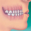 underbite teeth and orthodontics - colgate au