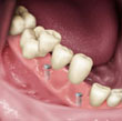artificial teeth implant for seniors - colgate au